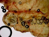 Mijten bij scabies crustosa