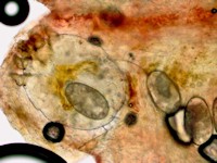 Mijten bij scabies crustosa