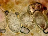 Mijten bij scabies crustosa