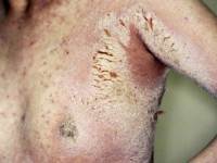 Scabies (schurft)