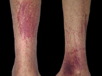 Purpura bij vitamine C deficientie