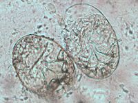 Scabies mijten in het KOH preparaat