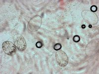 Scabies mijten in het KOH preparaat