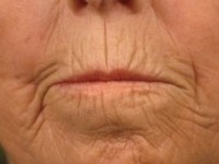 Microstomie met radiaire groeven