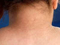 Scleroedema diabeticorum