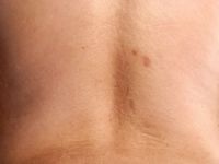 Scleroedema diabeticorum