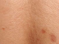 Scleroedema diabeticorum