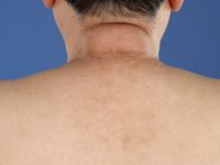 Scleroedema van Buschke