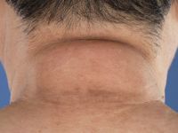 Scleroedema van Buschke