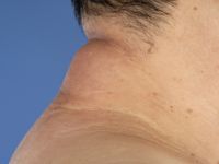 Scleroedema van Buschke