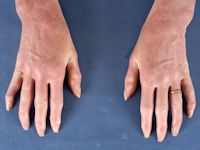 Sclerodermiforme veranderingen bij scleromyxoedeem van Arndt-Gottron