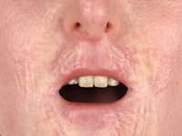 Sclerodermiforme veranderingen bij scleromyxoedeem van Arndt-Gottron