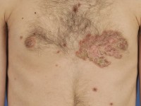 Sebopsoriasis