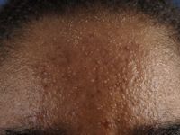 Seborroea (vette huid)