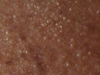 Seborroea (vette huid)