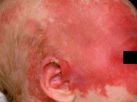 Segmentaal hemangioom