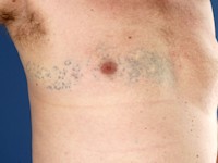 Segmentale glomangiomas