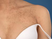 Segmentale lentiginosis