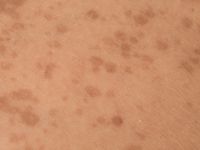 Segmentale lentiginosis