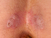 Seniele gluteale dermatose