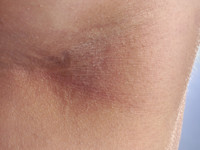 Seniele gluteale dermatose