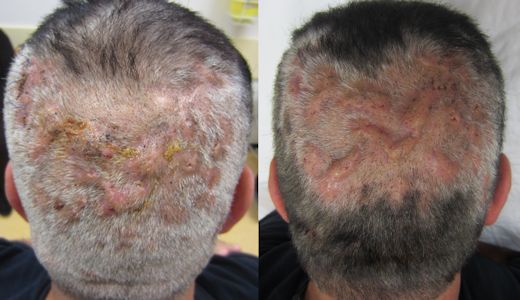 Perifolliculitis capitis abscedens et suffodiens (dissecting folliculitis)