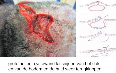 Perifolliculitis capitis abscedens et suffodiens (dissecting folliculitis)