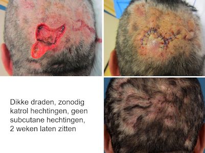 Perifolliculitis capitis abscedens et suffodiens (dissecting folliculitis)