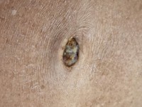 Sister Mary Joseph’s nodule