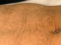 Sjögren-Larsson syndroom