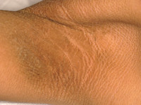 Sjögren-Larsson syndroom