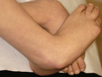 Sjögren-Larsson syndroom