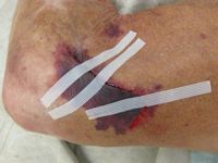 Skin tear, lapwond
