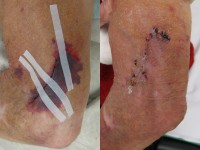 Behandeling van een skin tear (lapwond) met siliconen verband