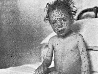 Pokken (variola major, smallpox)