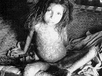 Pokken (variola major, smallpox)