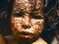 Pokken (variola major, smallpox)