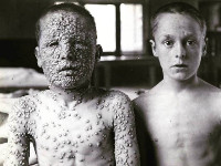 Pokken (variola major, smallpox)