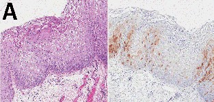 AIN-1 (anale intraepitheliale neoplasie graad 1)