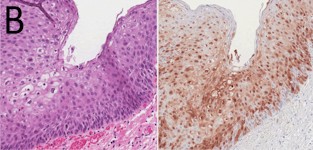 AIN-2 (anale intraepitheliale neoplasie graad 2)