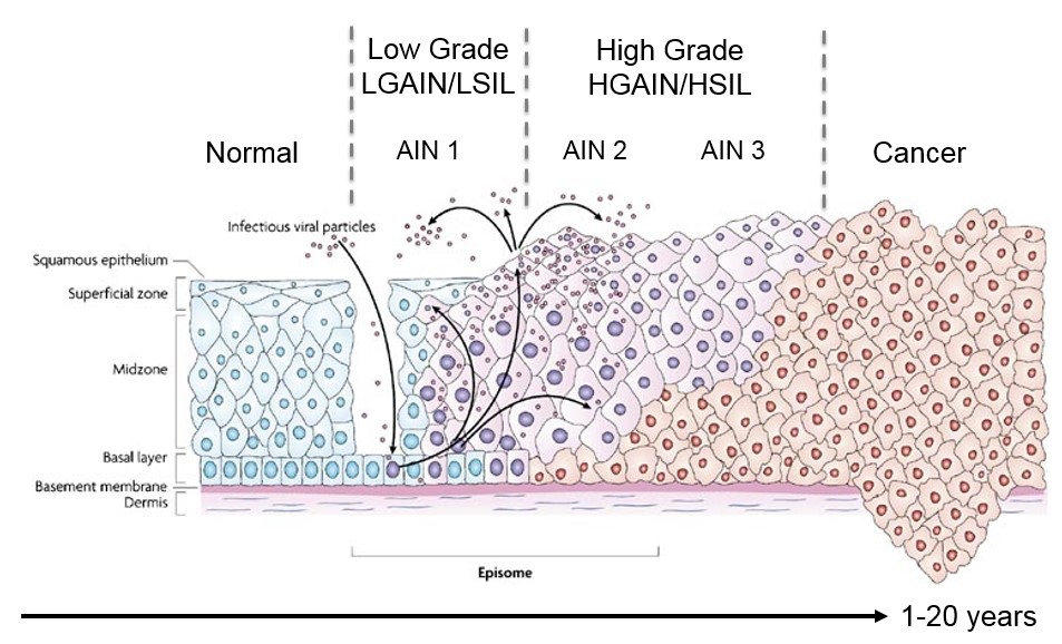 Gradaties van anale intraepitheliale neoplasie