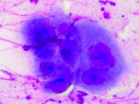 Tzanck test met multinucleate giant cells