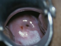 Bacterial vaginosis (Gardnerella vaginalis): foamy discharge from gas bubbles