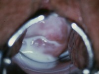 Bacteriele vaginose (Gardnerella vaginalis): schuimende fluor door gasbelletjes