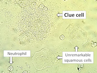 Clue cells