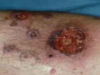 Lues 2, secundaire syfilis