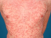 Lues 2, secondary syphilis