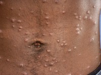 Lues 2, secundaire syfilis