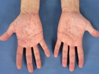 Lues 2, secondary syphilis