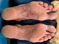 Lues 2, secundaire syfilis